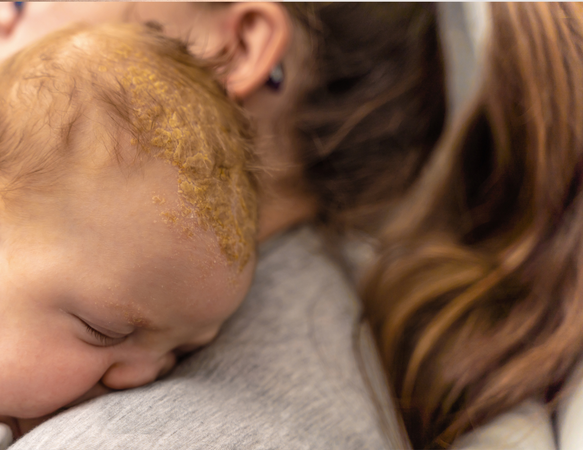 Cradle Cap: How to Treat it Fast